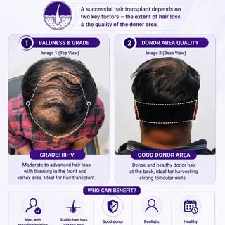 Not everyone with hair loss needs a hair transplant—but the right candidate can achieve life-changin