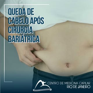 Você fez uma cirurgia e percebeu uma perda de fios capilares significativa?
.
A queda de cabelo após