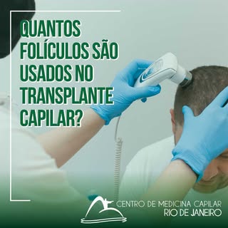 A unidade folicular retirada no transplante capilar, consiste em 1 a 4 folículos agrupados que compa