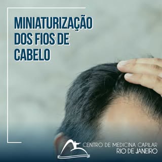 Miniaturização dos fios é o nome do processo que os cabelos afinam conforme o passar do tempo. Eles 
