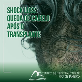 Os pacientes submetidos ao transplante capilar frequentemente se queixam de queda de cabelo após a c