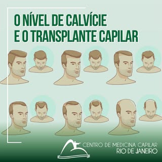 Existem 7 graus de queda de cabelo medidos pela escala de Norwood-Hamilton.
.
O ideal para um transp