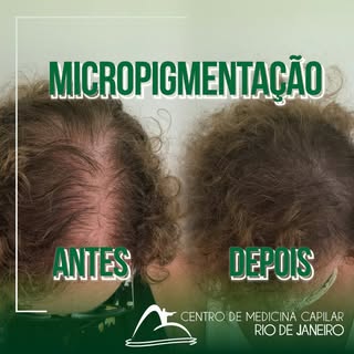 A Micropigmentação Capilar pode te ajudar a dar mais volume para o seu cabelo!

É uma técnica modern