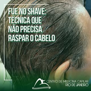 Já pensou em fazer o transplante capilar sem precisar raspar o cabelo?

A cirurgia FUE no-shave, ou 
