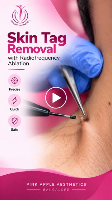 A closer look at skin tag removal using radiofrequency ablation ✨ Precise, targeted, and performed u