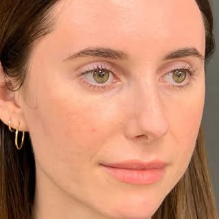 Subtle but significant changes from facial fat transfer: when we are born, our face is a ball of fat