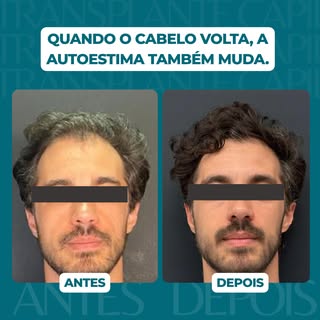 O problema nunca foi só a calvície...

Muita gente acredita que perder cabelo é apenas uma questão e