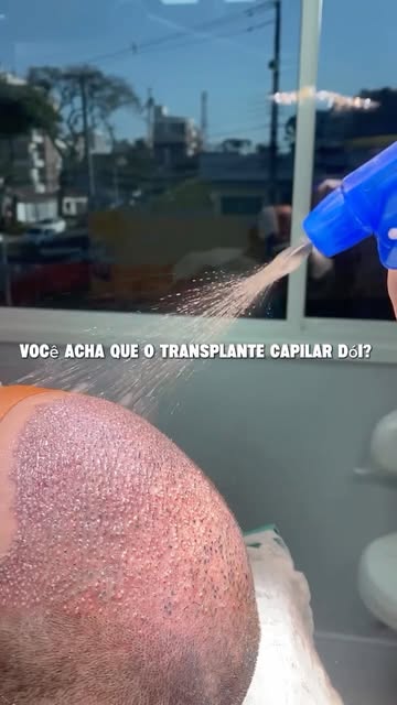 “Tenho medo de sentir dor no transplante capilar…”

Essa é uma das frases que mais ouvimos. E a boa 