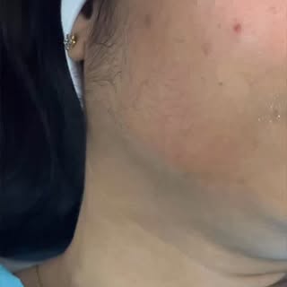 Patient concern: Dehydrated, dull skin

Treatment performed: Skin hydration therapy
This procedure h