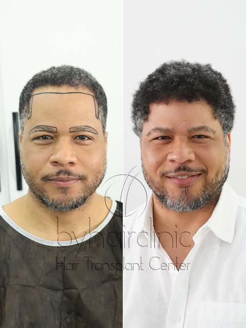 Hair & Eyebrow Transplant Transformation ✨

A complete transformation for Isreal Mallrd, who underwe