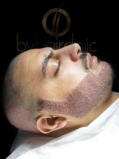 Un résultat naturel, une planification précise et une application méticuleuse…

La greffe de barbe p