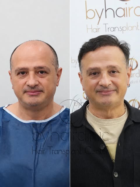 ✨ Natural Hair. Real Results.

A personalized hair transplant journey can make a visible difference 
