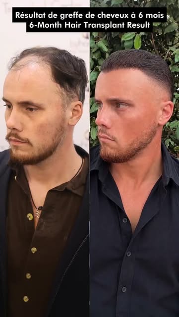 6 mois après sa greffe de cheveux ✨

Sébastien Châtelet, venu de l’Essonne en France, a choisi byhai