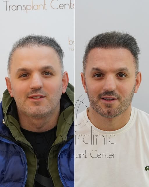 Résultat à 6 mois après une greffe de cheveux

Six mois après l’intervention, l’évolution devient de