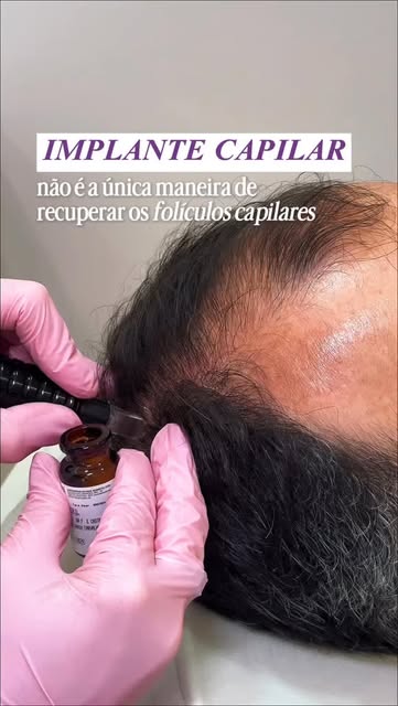 Antes de pensar em implante capilar, existe uma pergunta importante: esses folículos realmente deixa