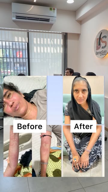Patient from banaskatha came all the way to Ahmedabad for treatment for life threatening skin reacti