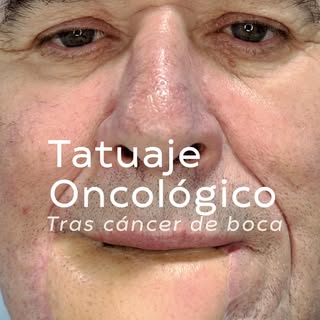 🎗️Tatuaje oncológico tras #maxilectomia. Reconstruimos ópticamente la cavidad oral de nuestro pacie