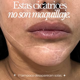 A veces una cicatriz no solo deja una marca en la piel.

En este caso, trabajamos una zona facial es