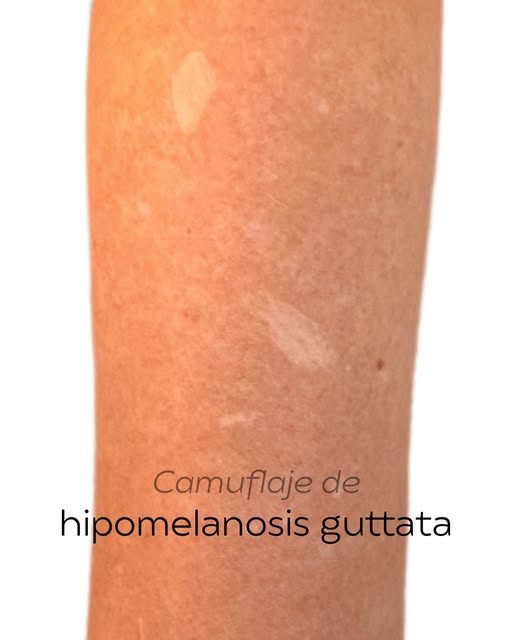 ✨ ¿Manchitas blancas en brazos o piernas?

La hipomelanosis guttata son pequeñas manchas blancas que