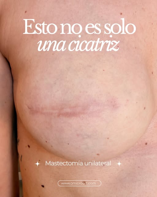Después de una mastectomía, volver a mirarte al espejo también puede formar parte del proceso. 🤍

E