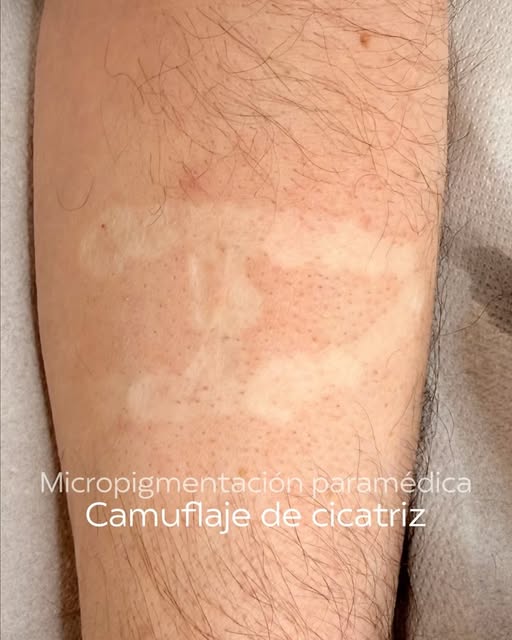 ✨ Camuflar una cicatriz es mucho más que igualar el color de la piel.

En este caso, además de traba