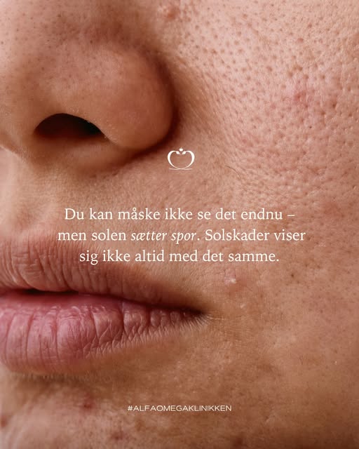 Du kan måske ikke se det endnu men solen sætter spor.

Selv når huden får en flot glød, kan UV-strål