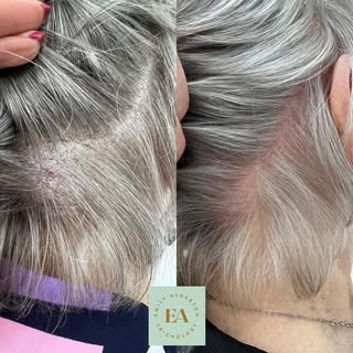 ✨ Scalp Psoriasis ✨

Scalp psoriasis can be a persistent and distressing condition, with symptoms li