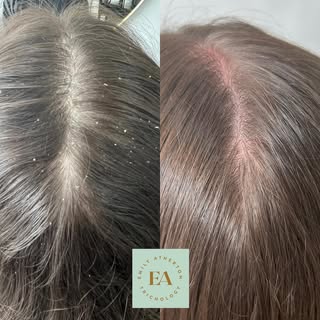 📸 Before & After: Scalp Detox Success 🌿

✨ One session. Big difference.

This patient came to clin