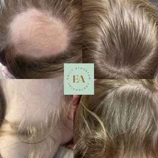 ✨ Alopecia Areata Success Story ✨
(Shared with permission, identity protected-before & after progres