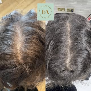 Male Pattern Hair Loss (AGA) – Early Intervention Matters 👇🏼

These photos were taken just 4 month