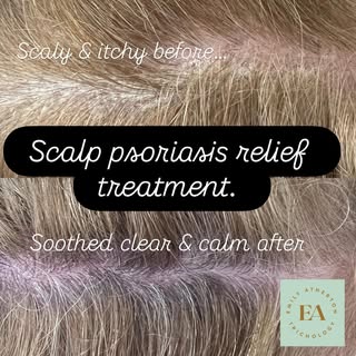 ✨Scalp Psoriasis – Before & After Keratolytic Treatment✨

These images show the scalp before and imm