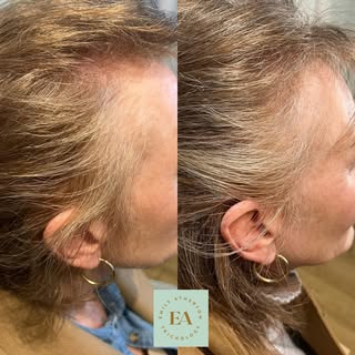 ✨Before and after shots of the parting and hairline just a few months apart.

We are already seeing 