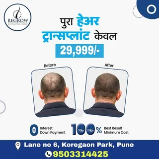 Unlimited Hair grafts Transplant for only Rs. 29,999/-
✔️100% Result 
✔️0% Interest 
✔️0% Down Payme