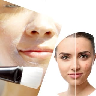 A chemical peel is a cosmetic procedure used to improve the appearance and texture of the skin on th