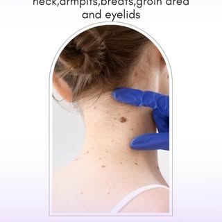 A skin tag, also known as an acrochordon, is a small, benign growth that appears on the surface of t