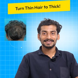 GFC Treatment acts as a natural hair growth booster.It helps prevent hair loss in just two sessions 