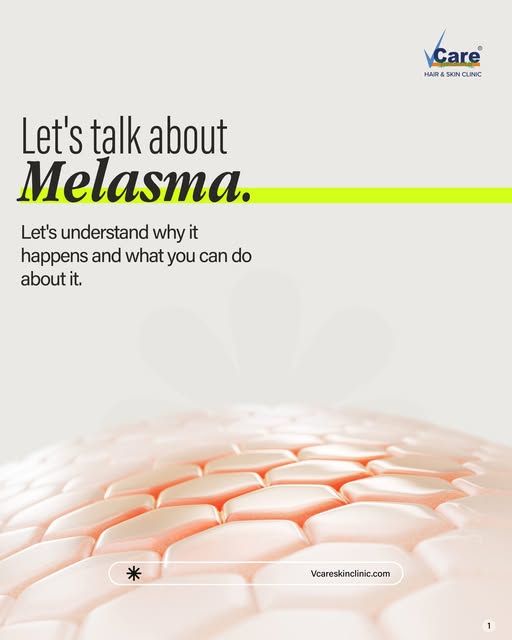 Understanding Melasma for Healthier-Looking Skin

 Melasma is more than just pigmentation—it's a con