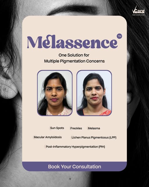 Every Pigmentation Concern. The Right Care = VCARE

Pigmentation isn't one-size-fits-all. Whether it