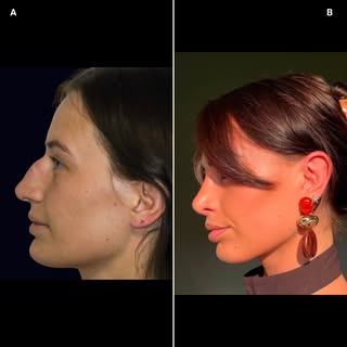 Happy patient after open septorhinoplasty after 4.5 months.  Earlier I posted her 1 week post op pho
