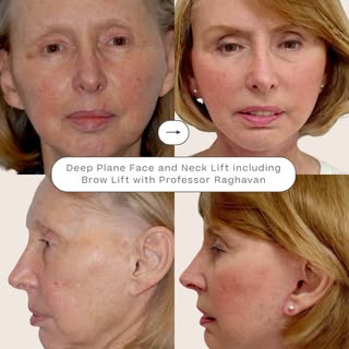 77-year-old Pauline’s beautiful transformation following a Face and Neck Lift with Brow Lift by Prof