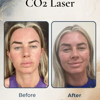 CO₂ laser recovery changes quite quickly in the first few days, and every stage can look a little di