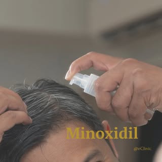 Minoxidil is inmiddels een van de bekendere middelen dat wetenschappelijk bewezen is dat haarverlies