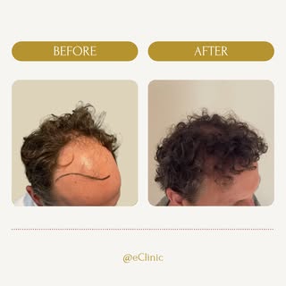 Wauw wauw wauw!

Deze jongeman heeft een jaar geleden bij ons een haartransplantatie behandeling ond