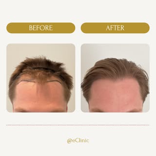 Kijk eens!🤩

Een heel mooi en natuurlijk resultaat.
Tijdens deze haartransplantatie behandeling heb