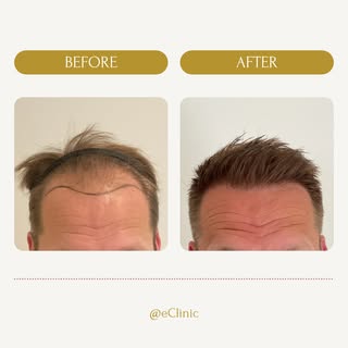 Hier worden wij blij van!

Tijdens deze haartransplantatie behandeling hebben we een nieuwe haarlijn