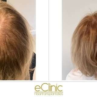 Een heel mooi resultaat met PRP!! een haartransplantatie is niet altijd nodig. #haartransplantatie #