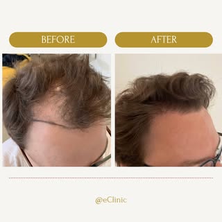 Weer een zeer tevreden klant. We zijn lekker bezig! #haartransplantatie #haar #larennh #haarbehandel