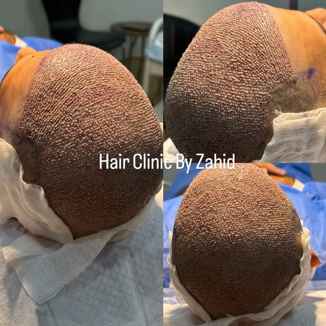 Hair clinic by zahid 5500 Grafts
#HairclinicbyZahid 
#hairtransplantlahore 
#hairrestoration 
#hairt