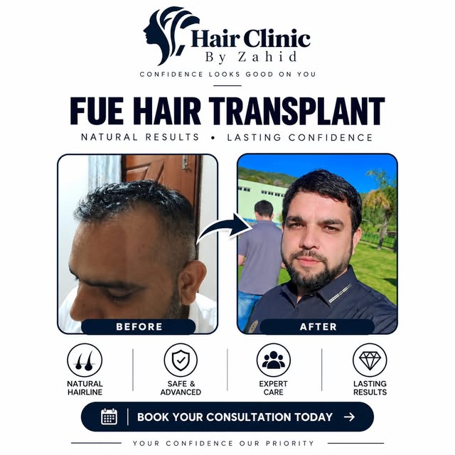 FUE Hair Transplant — Natural Results, Lasting Confidence ✨
Restore your hair. Rebuild your confiden