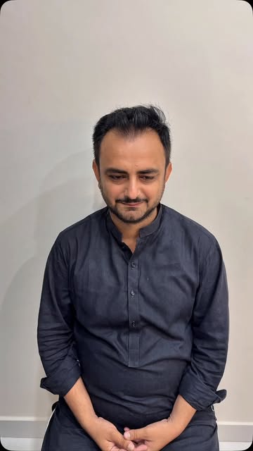 Fue Chinese method hair transplant
